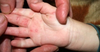 Trẻ vẫn có thể nhiễm bệnh tay chân miệng nhiều lần