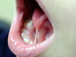 D&iacute;nh lưỡi l&agrave; dị tật bẩm sinh v&agrave; ai cũng c&oacute; khả năng bị.