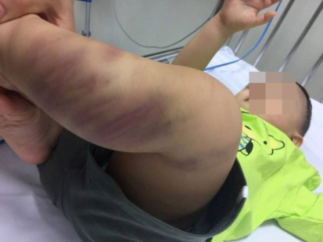Bé trai bị bạo hành chấn thương sọ não ở Hà Nội được xuất viện
