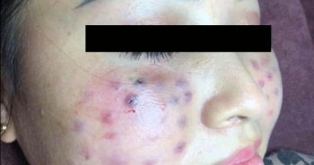 Hà Nội: Sau khi tiêm căng bóng da từ Spa "cỏ” mặt cô gái trẻ bị biến dạng kinh hoàng như  tổ ong