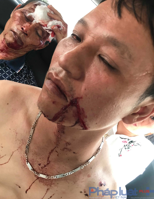 Nạn nhân Lê Bá Huy cùng bố đã bị đánh, bị bắn khiến phải nhập viện với sức khỏe yếu.