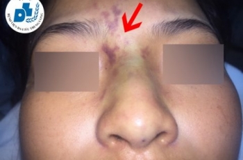 Nữ sinh 13 tuổi mất hoàn toàn thị lực sau khi làm mũi