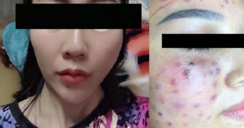 Vụ Spa "cỏ" tại  Hà Nội: Thêm một khách hàng bị lệch mặt sau khi tiêm má baby