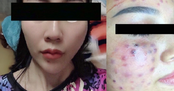 Vụ Spa "cỏ" tại  Hà Nội: Thêm một khách hàng bị lệch mặt sau khi tiêm má baby