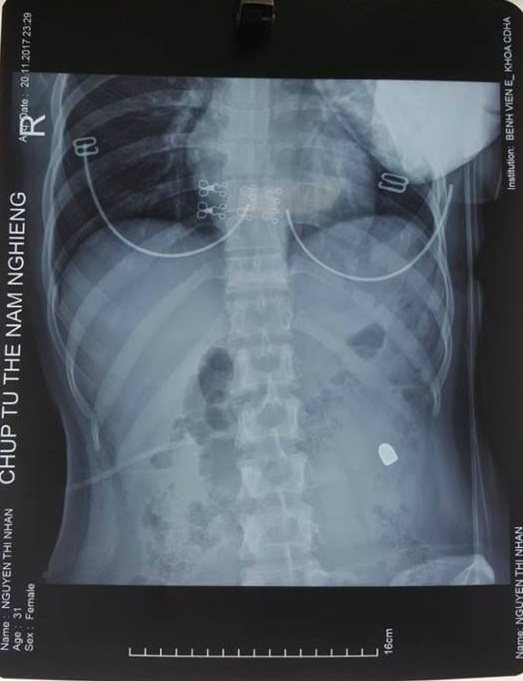 Kết quả chụp Xquang cho thấy c&oacute; một đầu đạn trong ổ bụng bệnh nh&acirc;n.