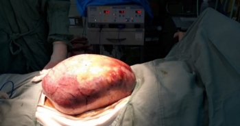 Mổ tách khối u "khủng" nặng 5kg, cứu sống cô gái trẻ ở Quảng Bình