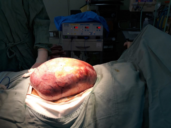 Cận cảnh khối u khổng lồ được lấy ra từ trong bụng c&ocirc; g&aacute;i trẻ. (Ảnh. L.C).
