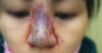 Nữ sinh 19 tuổi bị hoại tử mũi sau khi nâng mũi