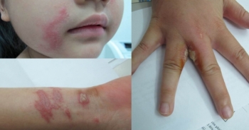 Cảnh báo dễ tổn thương da nghiêm trọng do tiếp xúc với kiến ba khoang