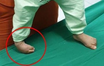 Bác sĩ "uốn" chân cong thành thẳng cho bé 16 tháng tuổi