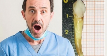 Lập kỷ lục thế giới nhờ chiếc răng dị thường