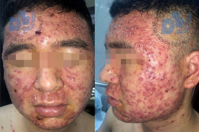 Bệnh nhân nam, 22 tuổi, nhiều tổn thương sẩn, mụn mủ trắng, mụn viêm đỏ vùng mặt. Ảnh: BV Da liễu TƯ