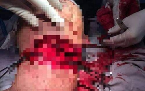 Lâm Đồng: Chồng dùng dao cắt cổ vợ rồi tự sát, cả 2 may mắn thoát chết