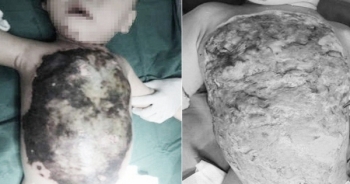 Xót xa, bé 13 tháng tuổi hoại tử, nhiễm trùng nặng vì chữa bỏng theo cách của thầy lang