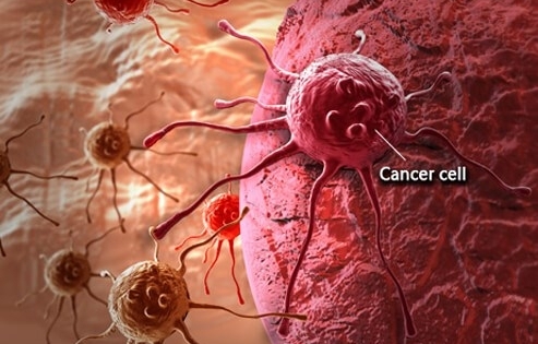 Phát hiện phương pháp "vô hiệu hóa" sự lan rộng tế bào ung thư