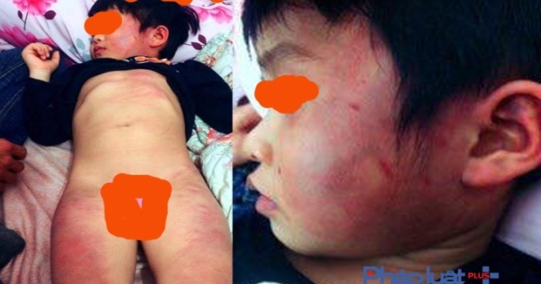 Bắc Giang: Cháu bé bị thâm tím toàn thân, gia đình nghi bị bạo hành ở lớp