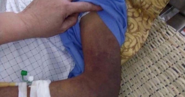 Nghệ An: Con ruột đánh cha gãy xương sườn, toàn thân bầm tím phải nhập viện cấp cứu