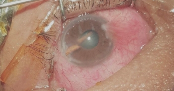 Chấn thương nặng vì dụi mắt sau khi bị gai mây đâm xuyên nhãn cầu