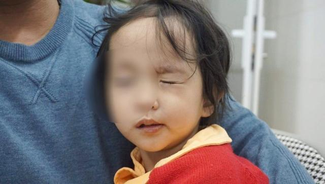 Trẻ liệt mặt, m&eacute;o miệng điều trị tại Bệnh viện Ch&acirc;m cứu Trung ương.