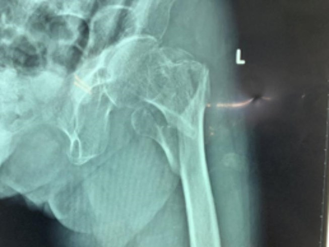 Kết quả chụp X-quang cho thấy xương đ&ugrave;i tr&aacute;i b&agrave; H. bị g&atilde;y nhiều mảnh. Ảnh: H&ograve;a Kh&aacute;nh