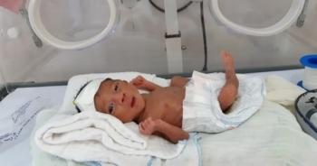 Bệnh viện tuyến huyện lần đầu nuôi sống bé sinh non 900g