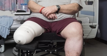 Người đàn ông mất chân ở tuổi 50 vì không nghe theo lời khuyên của bác sĩ