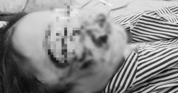 Tuyên Quang: Bé gái 10 tuổi bị chó cắn khiến mặt bị biến dạng