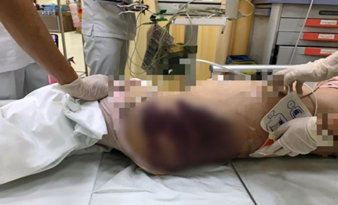 Những vết bầm lớn được xác định xuất hiện trên cơ thể bé gái 8 tuổi khi nhập viện.