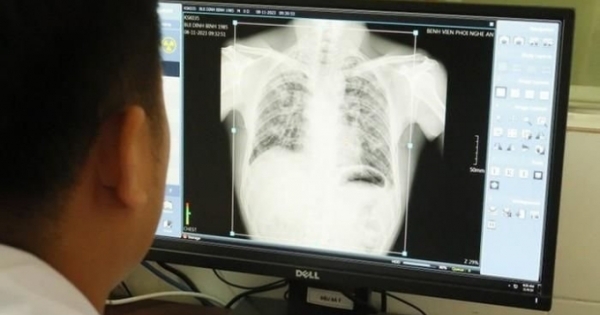 Thêm 57 người từng làm tại Công ty Châu Tiến mắc bệnh do bụi phổi